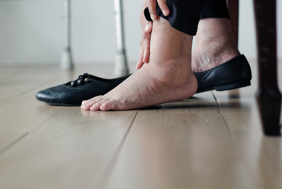 Kaki dan pergelangan kaki ibu hamil terlihat membengkak, menggambarkan kondisi kaki bengkak yang umum terjadi selama kehamilan.